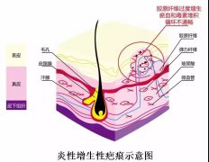 烧烫伤为什么容易引起疤痕增生?